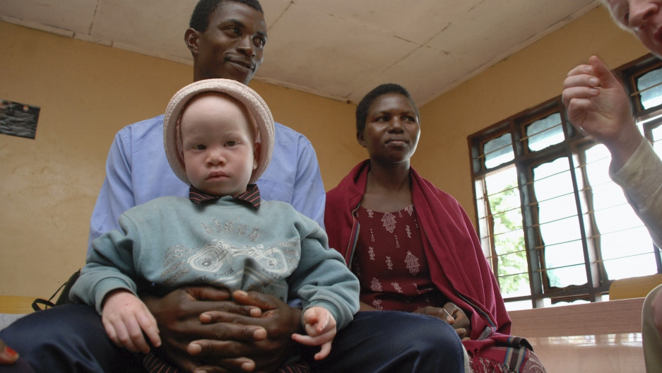 Kisah Pilu Orang Albino di Afrika, Diburu Demi Kekuatan Magis