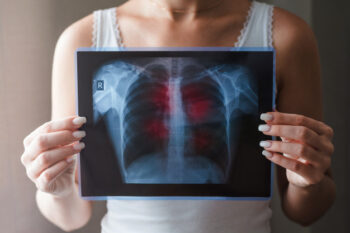 Bagaimana Sih Cara Mendeteksi Penyakit TBC yang Benar?