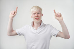 Mengenal Penyebab Albino dan Jenis-Jenisnya