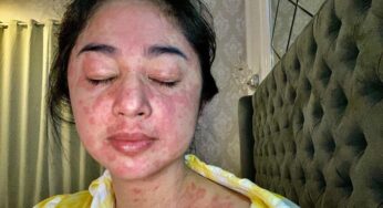 Ruam Di Kulit Bisa Jadi Pertanda Covid-19, Kenali Gejalanya